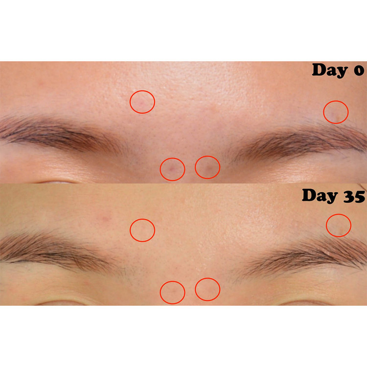 سرم ضدلک اکیسیس وای ساخت کره