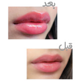 حجم دهنده فوری لب Collagen