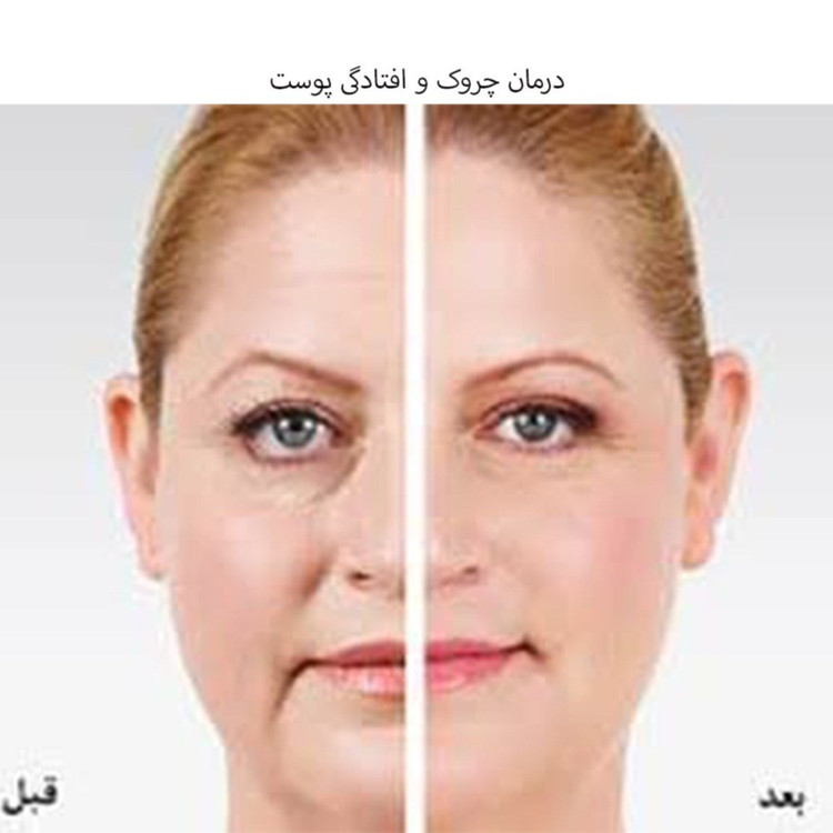 کرم رفع غبغب و چروک گردن ماساژور دار سادور